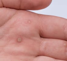 warts on fingers and the palm of the hand