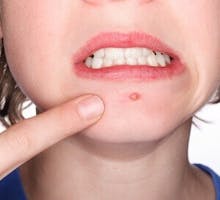 an acne pimple on a teenager's chin