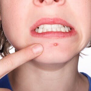 an acne pimple on a teenager's chin