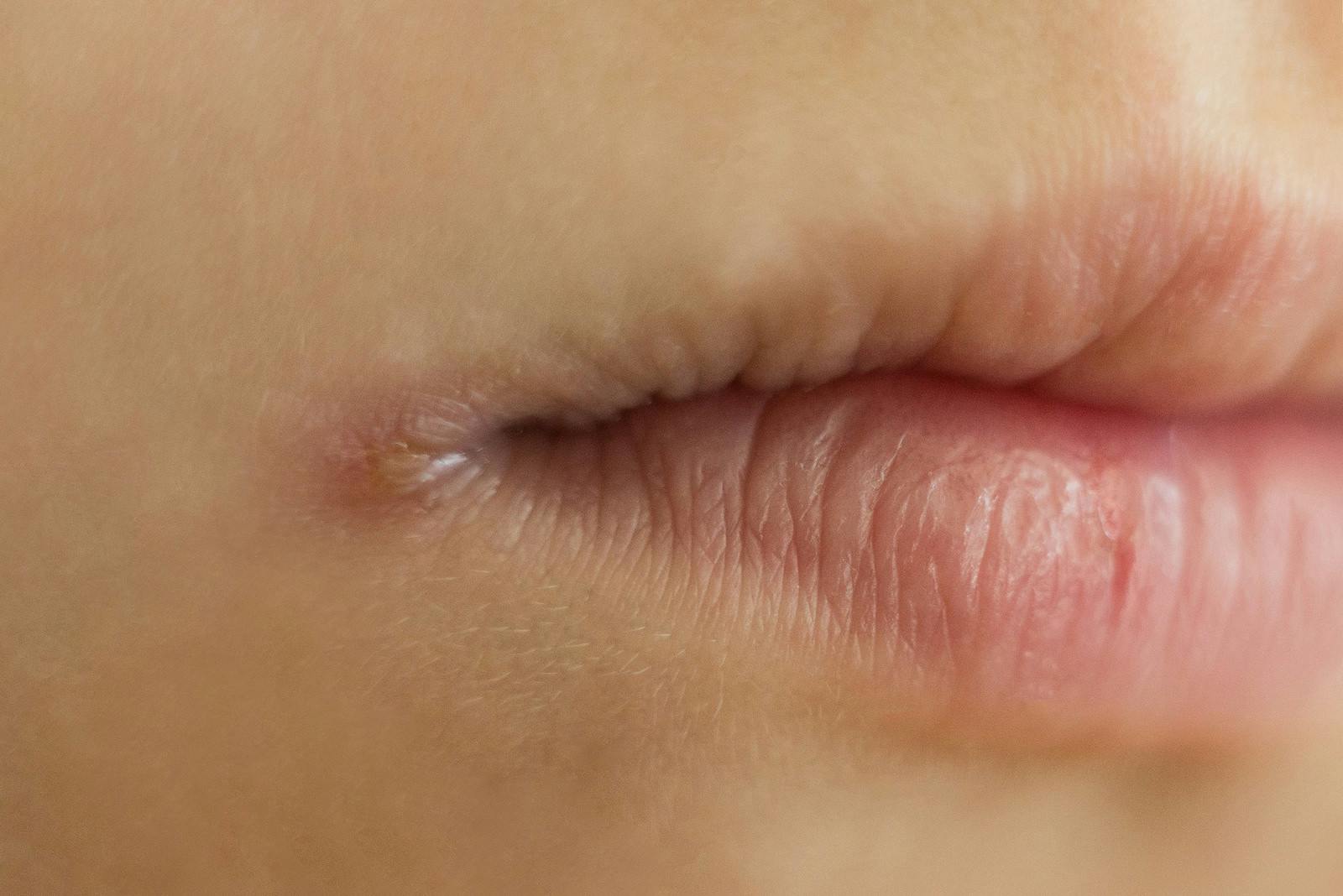 images Amber Listerine For Angular Cheilitis how can you control yeast overgrowth