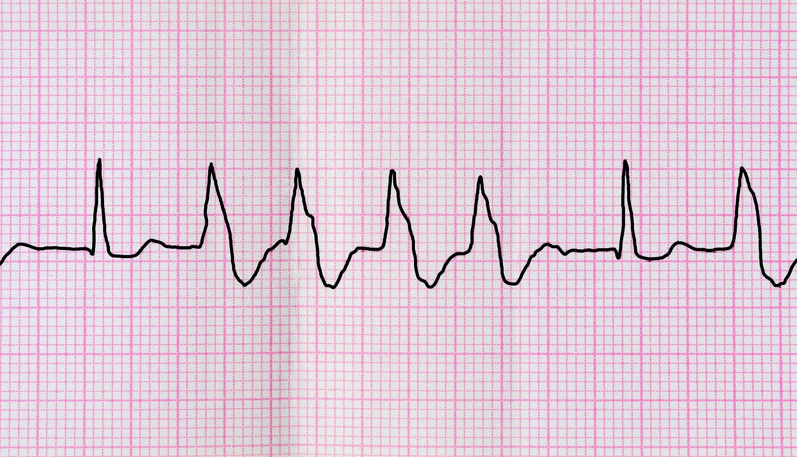Irregular ventricular heart rhythm on ECG