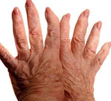 Hands With Arthritis
