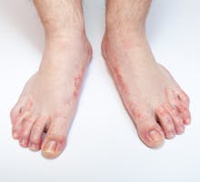 severe athlete's foot rash