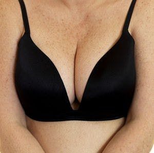 Breast Fungus Secrets Exposed - The People's Pharmacy
