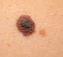 Close up picture of dangerous brown nevus on human skin - melanoma