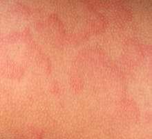 Close up image of a little boy's body suffering severe urticaria, hives