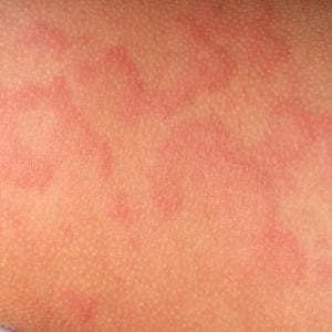 Vitamin D May Help Ease Persistent Hives The People S Pharmacy