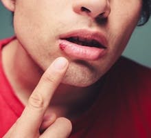 Young man is showing a cold sore (fever blister) on his lip