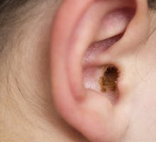 earwax in the ear