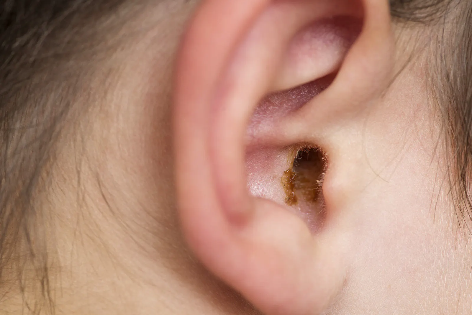 Laxative Helps Remove Earwax The People's Pharmacy