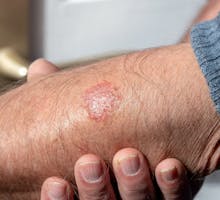 bad eczema rash on the arm of a man