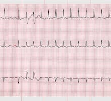 An electrocardiogram with evidence of atrial fibrillation, irregular heart rhythm