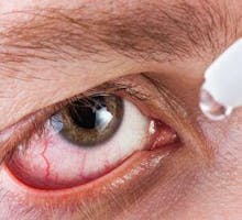 man putting eye drops in his bloodshot red eyes