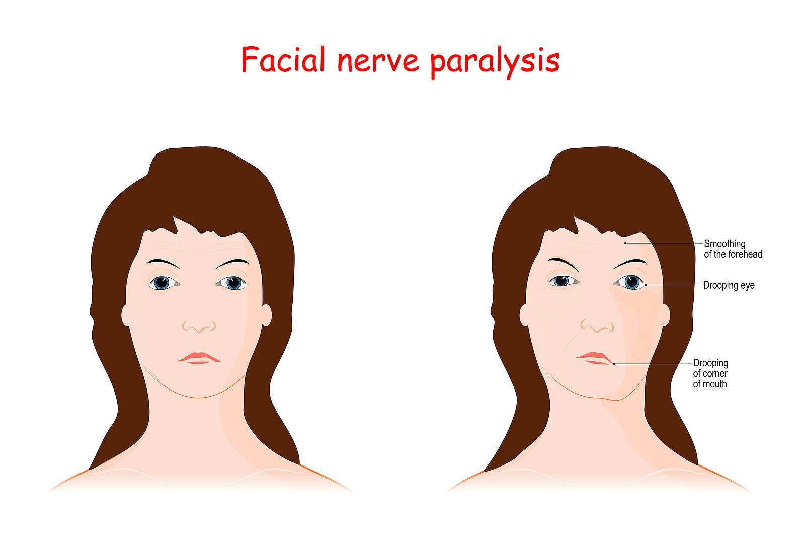 Bell's palsy or facial nerve paralysis