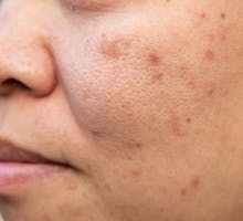 middle aged woman with stubborn blemishes on her cheeks