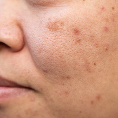 middle aged woman with stubborn blemishes on her cheeks