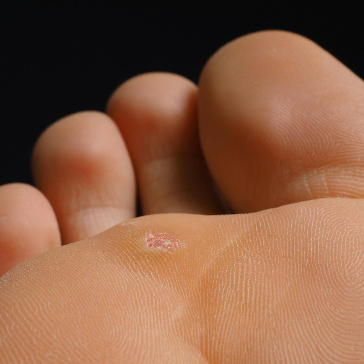 wart virus live on shoes)