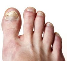 toes with unsightly nail fungus
