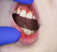 dental exam for gingivitis