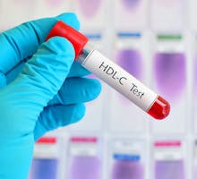HDL cholesterol blood test in a test tube