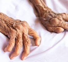 hands of an old woman with rheumatoid arthritis (RA)