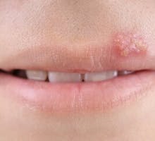 a cold sore outbreak on someone's lip