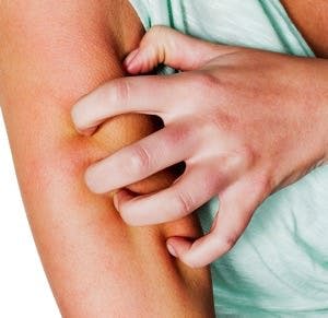 Woman scratching itchy arm