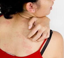 Young woman's back has unbelievable itching with allergy skin problem
