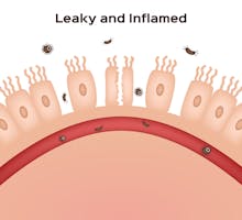 leaky gut syndrome graphic