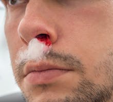 Man with bleeding nose and cotton in his nostril