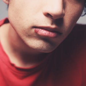 Young man with a cold sore on his lip
