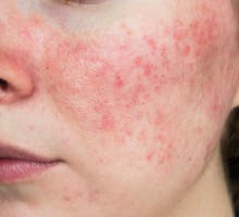 rosacea skin problem on woman's cheek