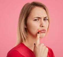 woman pointing to painful cracks in the corners of the mouth