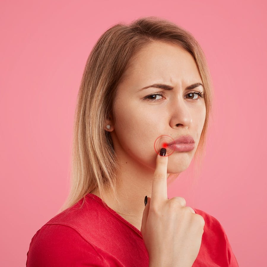 How to Cure Angular Cheilitis with Inexpensive Remedies | The People's Pharmacy How to Cure Angular Cheilitis with Inexpensive Remedies | The People's Pharmacy