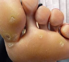 foot with plantar warts