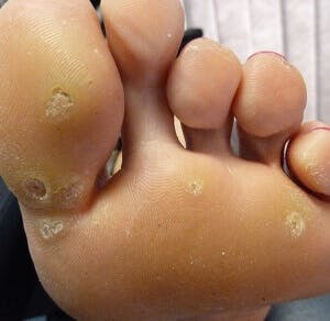 Wart on foot arch. Wart foot massage ‎A2Z of Dermatology în App Store