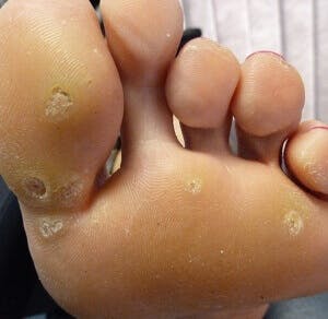 foot with plantar warts