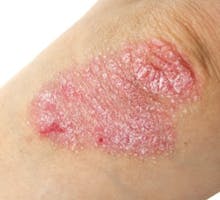 close up of Psoriasis on elbow