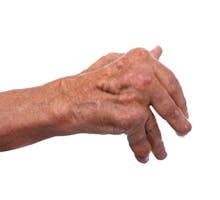 Man with severe arthritis of the hand causing deformation