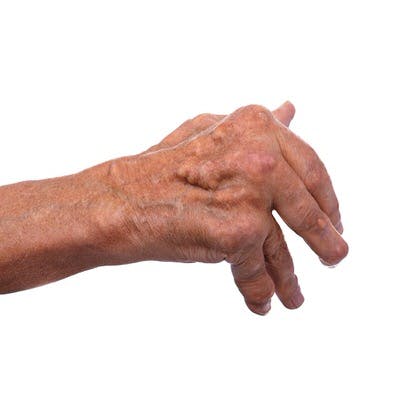 Man with severe arthritis of the hand causing deformation