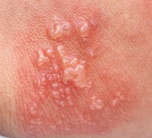 shingles (herpes zoster) skin rash