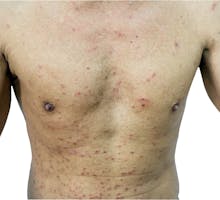 Skin rash on man's chest