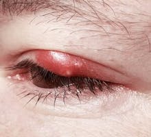 a swollen red eyelid showing a stye/blepharitis