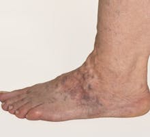 Varicose Veins On A Female Foot