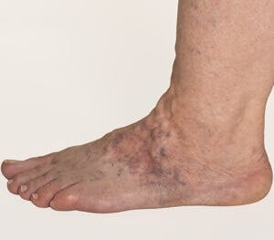 Erasing Spider Veins The People S Pharmacy