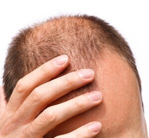 stressed man with a showing his balding head
