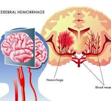medical illustration of the effects of the cerebral hemorrhage