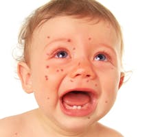 baby with measles rash