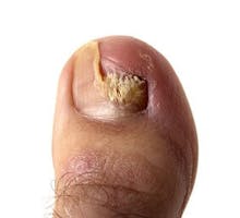 toe with nail fungus