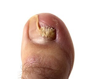 kezelés fungus nail iodine medicine köröm gomba az ujjak